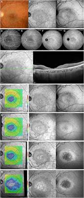 Case Report: Multimodal Imaging of Toxic Retinopathies Related to Human Immunodeficiency Virus Antiretroviral Therapies: Maculopathy vs. Peripheral Retinopathy. Report of Two Cases and Review of the Literature